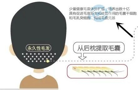 别拦我！我要取下秃顶“紧箍咒”